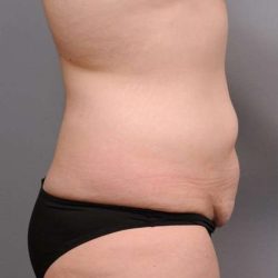 Tummy Tuck Before & After Patient #463