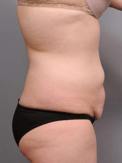 Tummy Tuck Before & After Patient #463