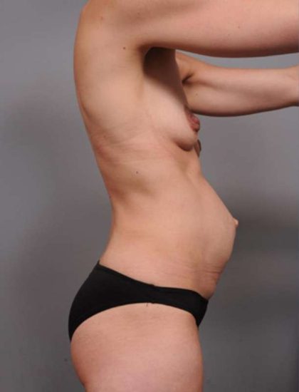 Mommy Makeover Before & After Patient #2520