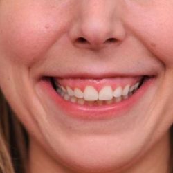 BOTOX® Cosmetic Before & After Patient #2531