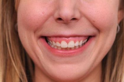 BOTOX® Cosmetic Before & After Patient #2531