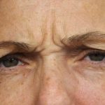 BOTOX&reg; Cosmetic Before & After Patient #2534