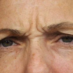 BOTOX® Cosmetic Before & After Patient #2534