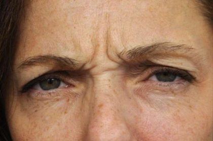 BOTOX® Cosmetic Before & After Patient #2534