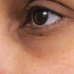JUVEDERM&reg; Before & After Patient #2537