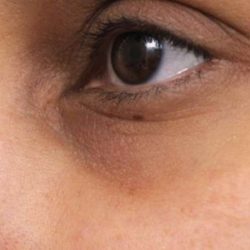 JUVEDERM® Before & After Patient #2537