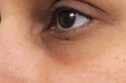 JUVEDERM® Before & After Patient #2537
