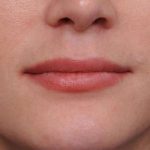 Lip Injections Before & After Patient #2540
