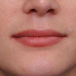 Lip Injections Before & After Patient #2540