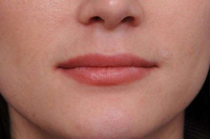 Lip Injections Before & After Patient #2540