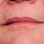 Lip Injections Before & After Patient #2543