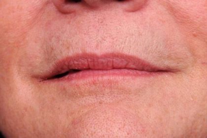 Lip Injections Before & After Patient #2543