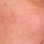 IPL Photofacial Before & After Patient #2548
