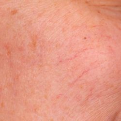 IPL Photofacial Before & After Patient #2548