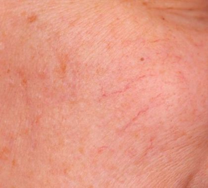 IPL Photofacial Before & After Patient #2548