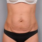 Tummy Tuck Before & After Patient #474