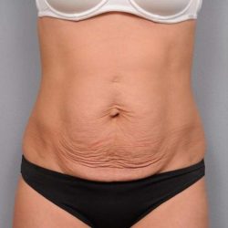 Tummy Tuck Before & After Patient #474