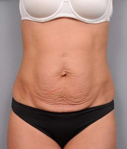 Tummy Tuck Before & After Patient #474