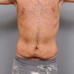 Tummy Tuck Before & After Patient #482