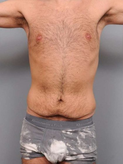 Tummy Tuck Before & After Patient #482