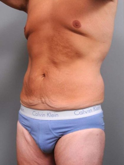 Tummy Tuck Before & After Patient #489