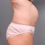 Tummy Tuck Before & After Patient #497