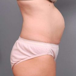 Tummy Tuck Before & After Patient #497