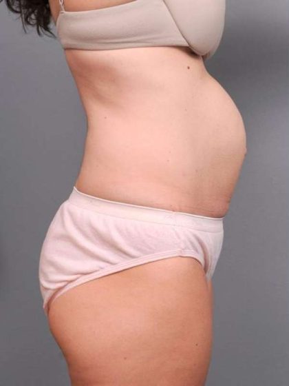 Tummy Tuck Before & After Patient #497