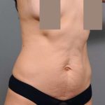 Tummy Tuck Before & After Patient #504