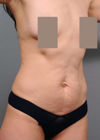 Tummy Tuck Before & After Patient #504