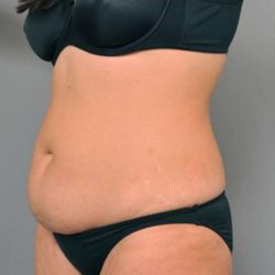 Tummy Tuck Before & After Patient #515