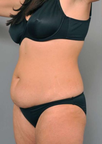 Tummy Tuck Before & After Patient #515