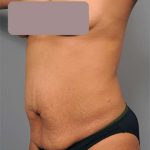 Tummy Tuck Before & After Patient #522