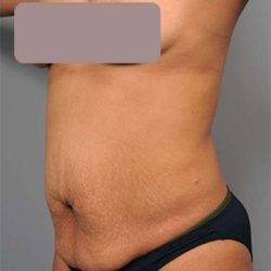 Tummy Tuck Before & After Patient #522