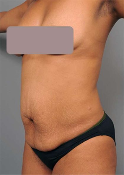 Tummy Tuck Before & After Patient #522