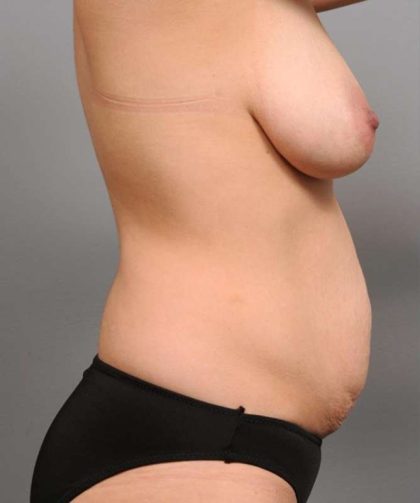 Tummy Tuck Before & After Patient #530