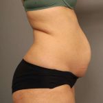 Liposuction Before & After Patient #550