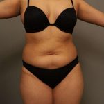 Liposuction Before & After Patient #563