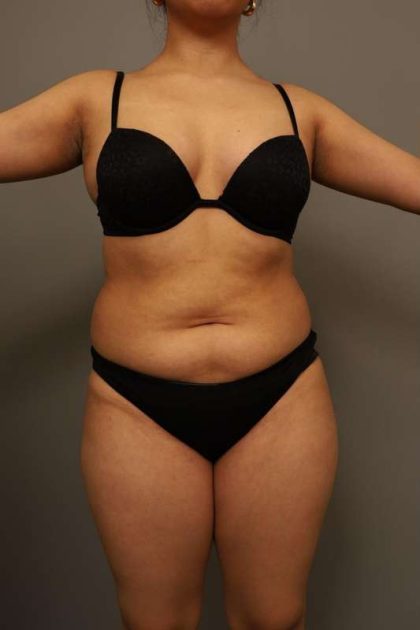 Liposuction Before & After Patient #563