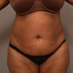 Tummy Tuck Before & After Patient #574