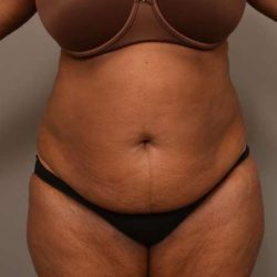 Tummy Tuck Before & After Patient #574