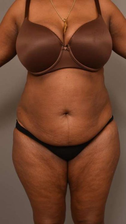 Tummy Tuck Before & After Patient #574