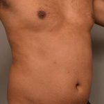 Liposuction Before & After Patient #581