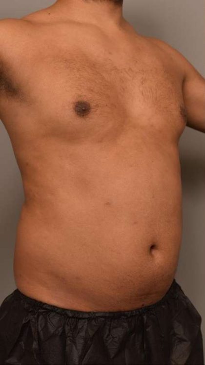 Liposuction Before & After Patient #581