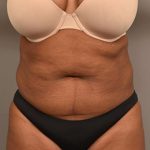 Liposuction Before & After Patient #604
