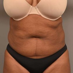 Liposuction Before & After Patient #604