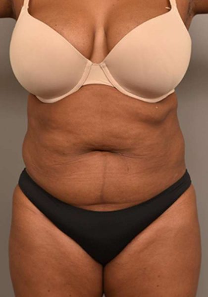 Liposuction Before & After Patient #604
