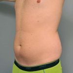 Liposuction Before & After Patient #611