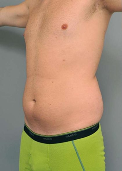 Liposuction Before & After Patient #611
