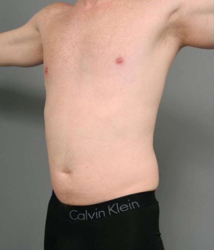 Liposuction Before & After Patient #618